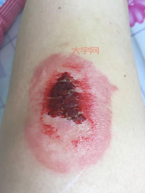 皮肤划伤了，碘伏和红药水能一起用吗？看完你就懂了