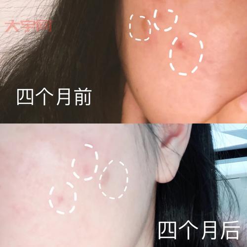 胶原蛋白注射隆鼻有风险吗？看完这篇就懂了！