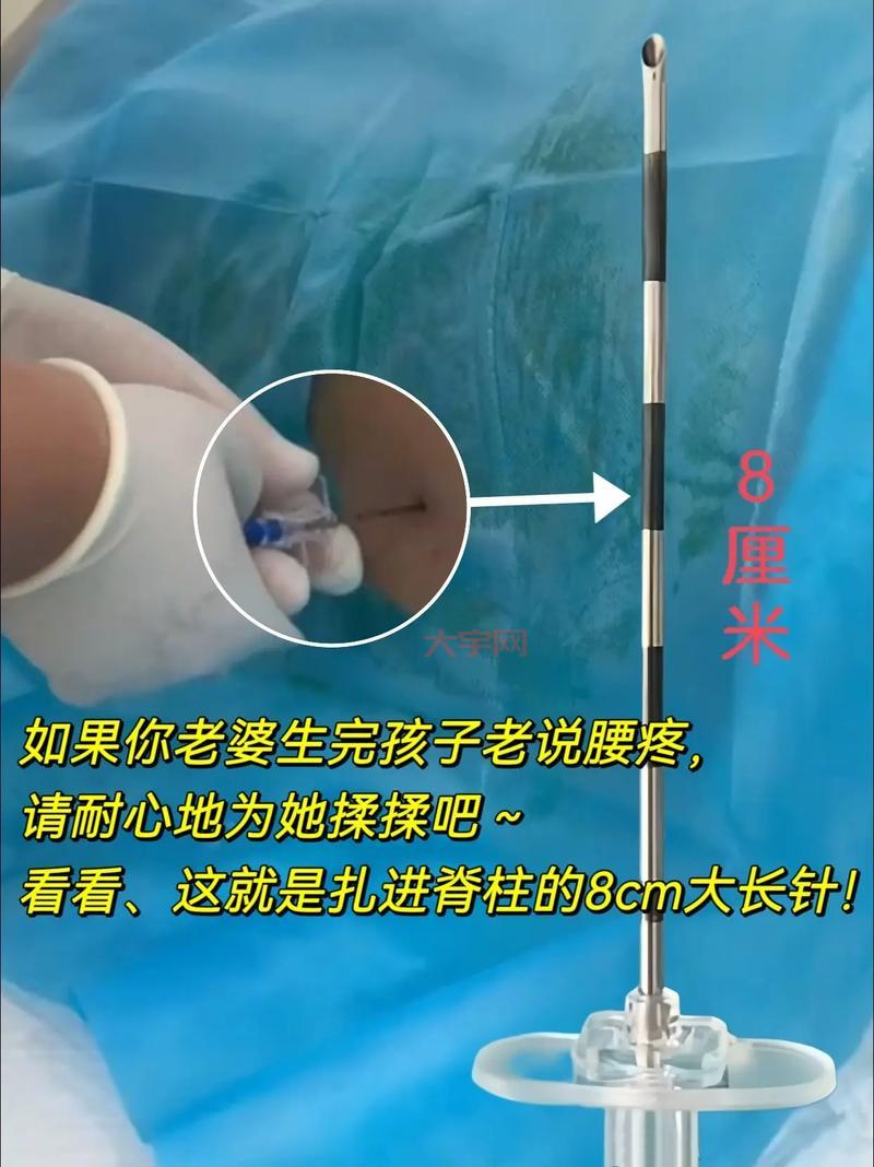 无痛分娩针有副作用吗？妇产科专家解读危害！